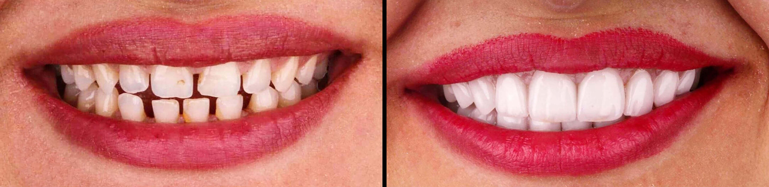 veneers