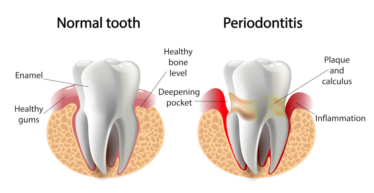 gum disease