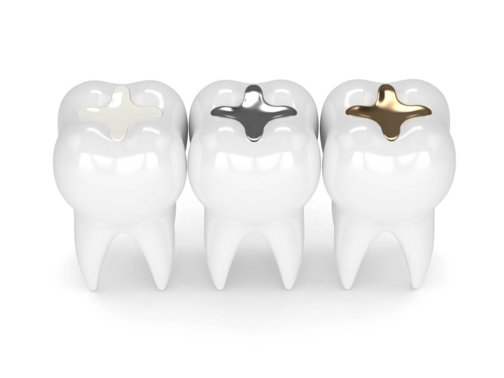 Composite, Gold, and Amalgam Fillings