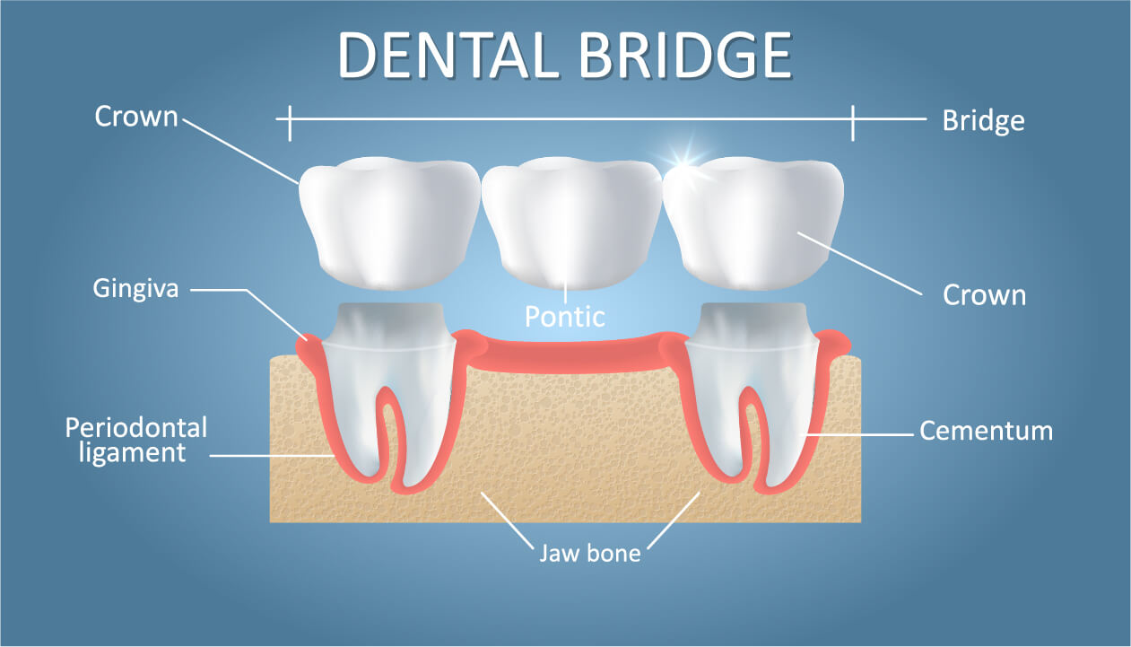 dental bridge