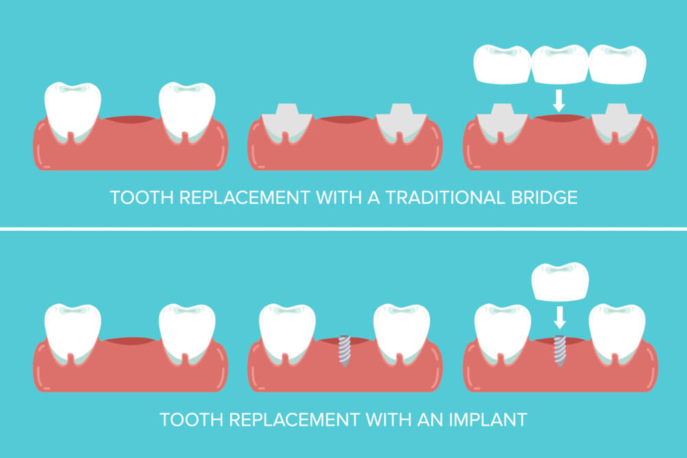 dental bridge vs implant