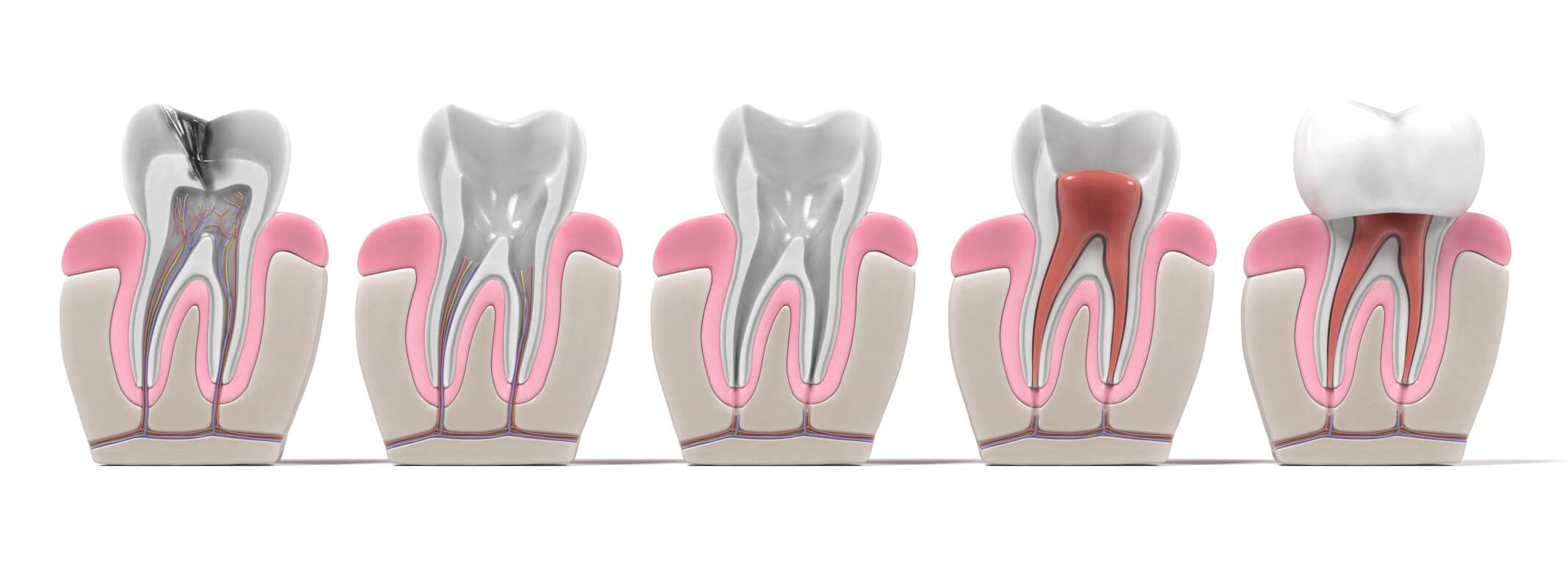 root canal